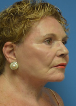 Facelift & Neck Lift