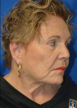 Facelift & Neck Lift