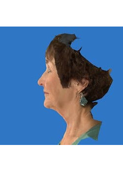 Facelift & Neck Lift