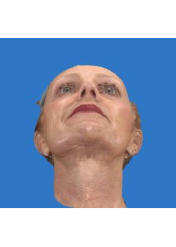 Facelift & Neck Lift