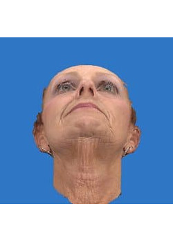 Facelift & Neck Lift