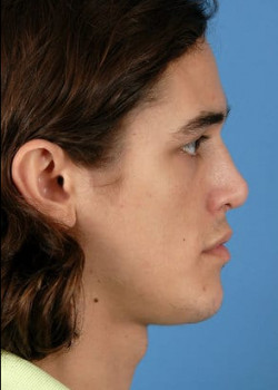 Rhinoplasty