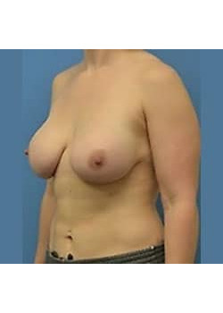 Breast Augmentation