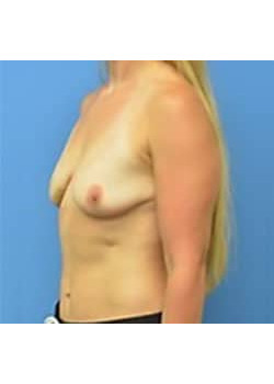 Breast Augmentation