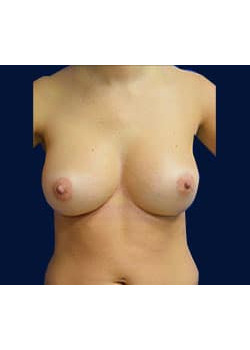 Breast Augmentation