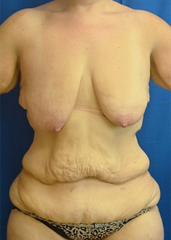 Breast Augmentation