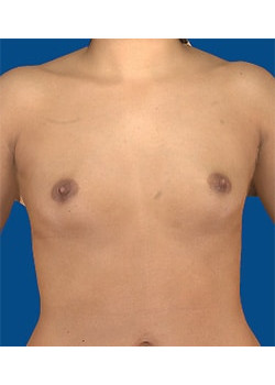 Breast Augmentation