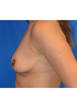 Breast Augmentation