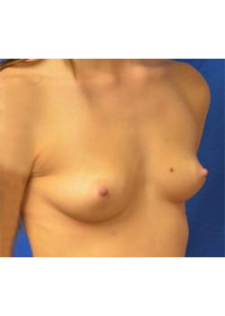 Breast Augmentation