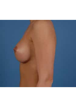 Breast Augmentation