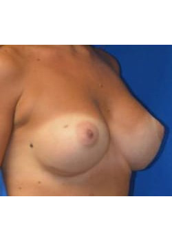 Breast Augmentation