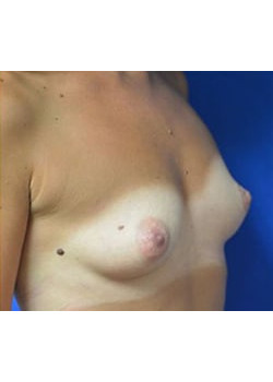 Breast Augmentation