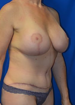 Breast Augmentation With Lift