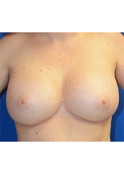 Breast Augmentation