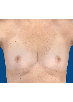 Breast Augmentation