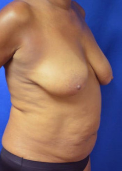 Breast Lift