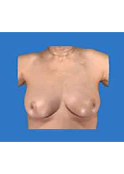 Breast Lift