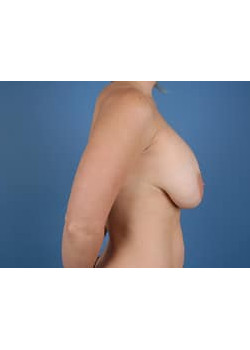 Breast Lift