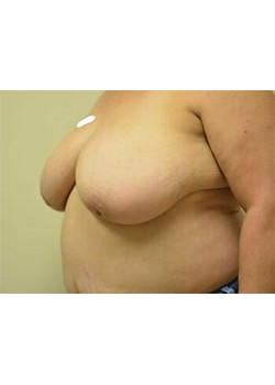 Breast Reduction