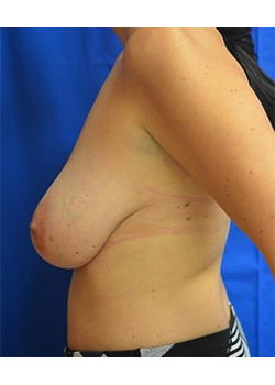 Breast Reduction