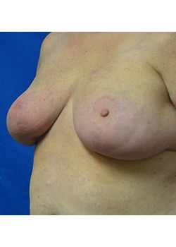 Breast Reduction