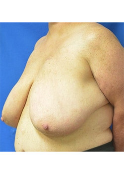 Breast Reduction