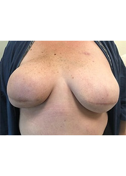 Breast Reconstruction