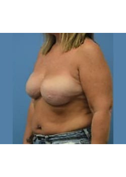 Breast Reconstruction