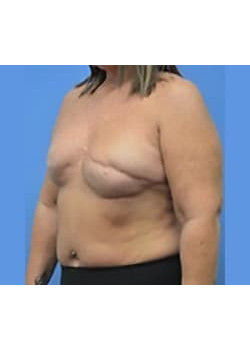 Breast Reconstruction