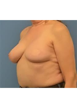 Breast Reconstruction