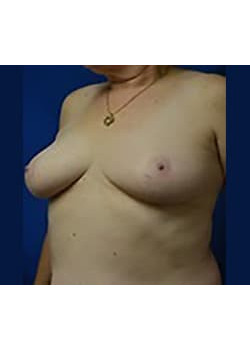 Breast Reconstruction