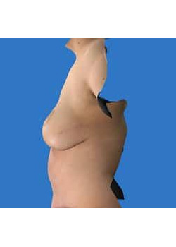 Breast Reconstruction