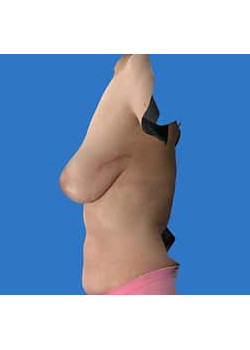 Breast Reconstruction