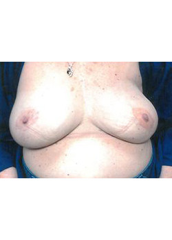 Breast Reconstruction