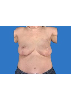 Breast Reconstruction