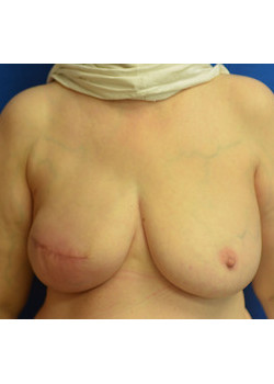 Breast Reconstruction