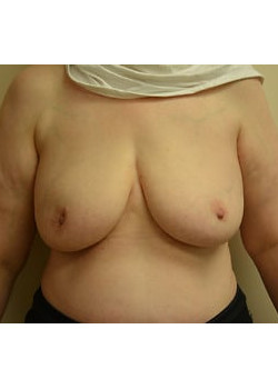 Breast Reconstruction