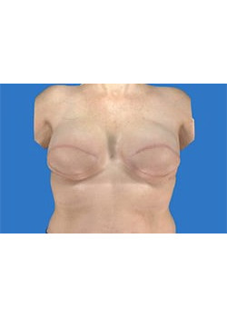 Breast Reconstruction