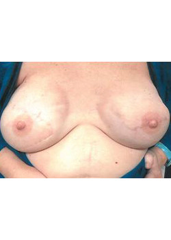 Breast Reconstruction