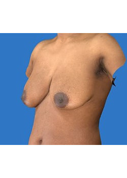 Breast Reconstruction