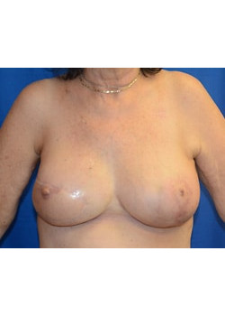 Breast Reconstruction