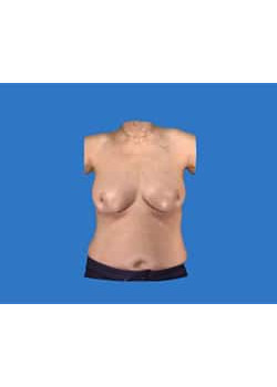 Breast Reconstruction