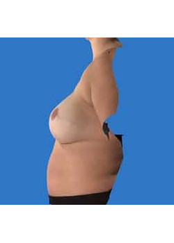 Breast Reconstruction