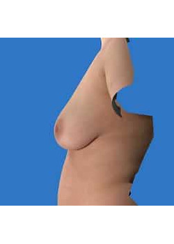 Breast Reconstruction