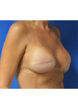 Breast Reconstruction