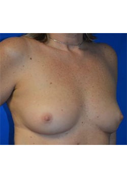 Breast Reconstruction