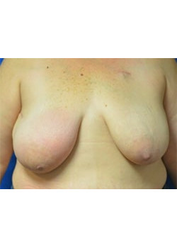 Nipple Reconstruction