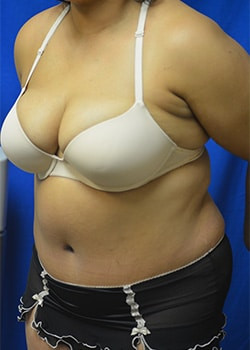 Tummy Tuck