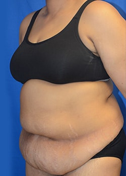 Tummy Tuck