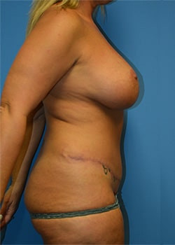 Tummy Tuck